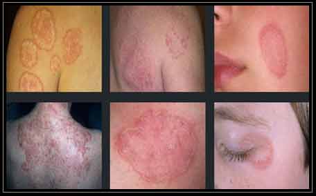 how to get rid of ringworm in humans