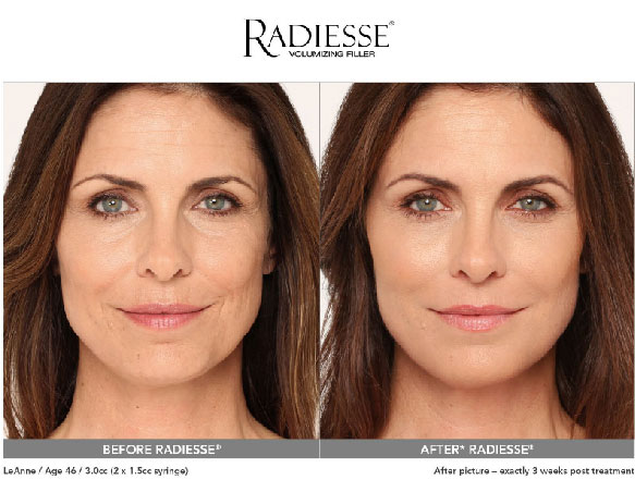 radiesse before and after under eyes